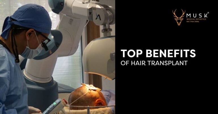 Top Benefits of Hair Transplant