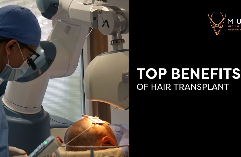 Top Benefits of Hair Transplant