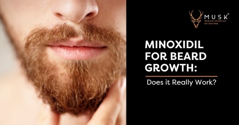 Minoxidil For Beard Growth: Does it Really Work?