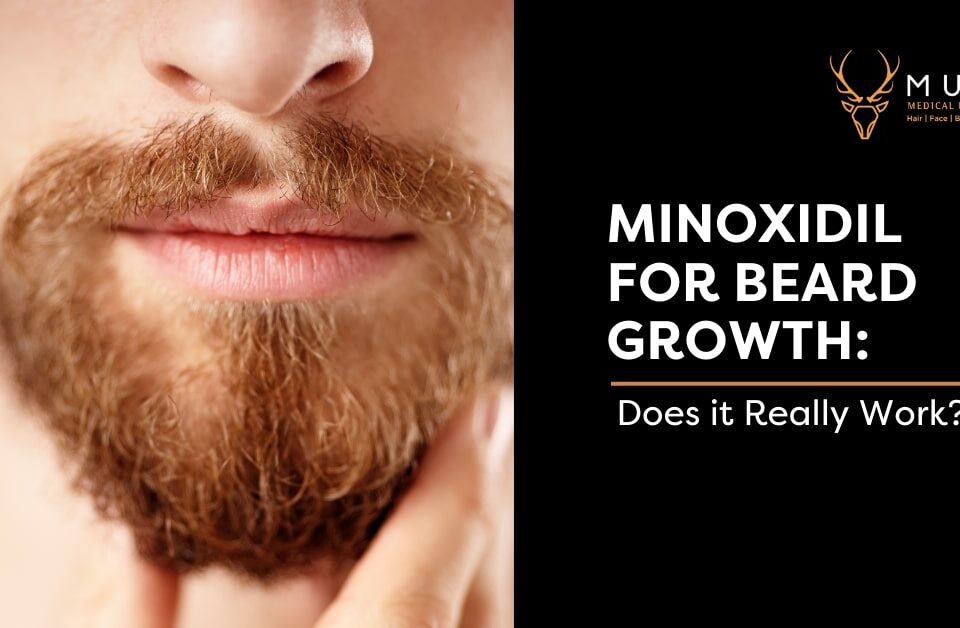 Minoxidil For Beard Growth: Does it Really Work?