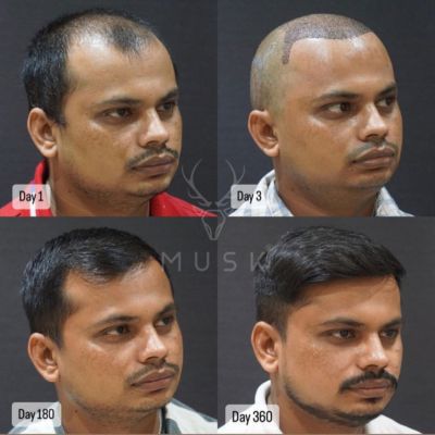 Hair Transplant Process