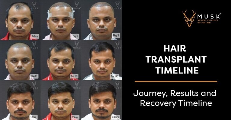 Hair Transplant Timeline: Journey, Results and Recovery Timeline