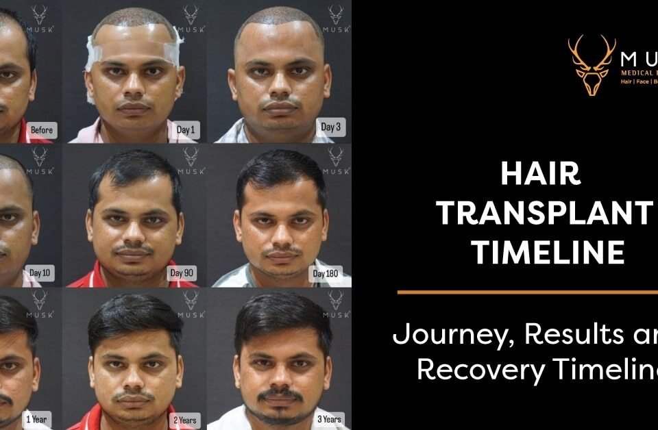 Hair Transplant Timeline: Journey, Results and Recovery Timeline