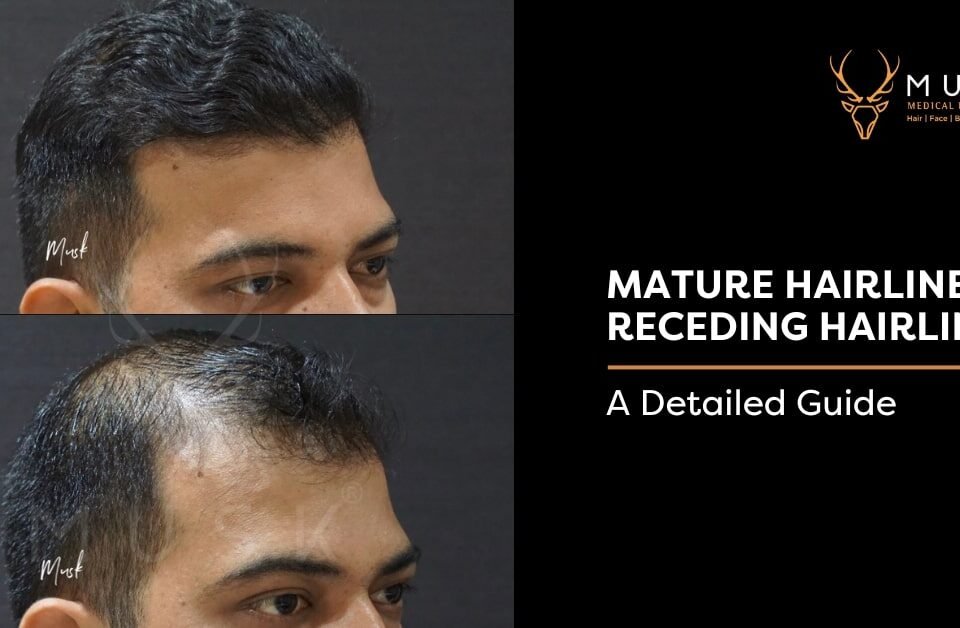 Mature-Hairline-Vs-Receding-Hairline-A-Detailed-Guide