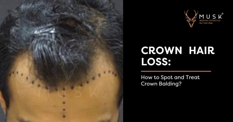 Crown-Hair-Loss-How-to-Spot-and-Treat-Crown-Balding