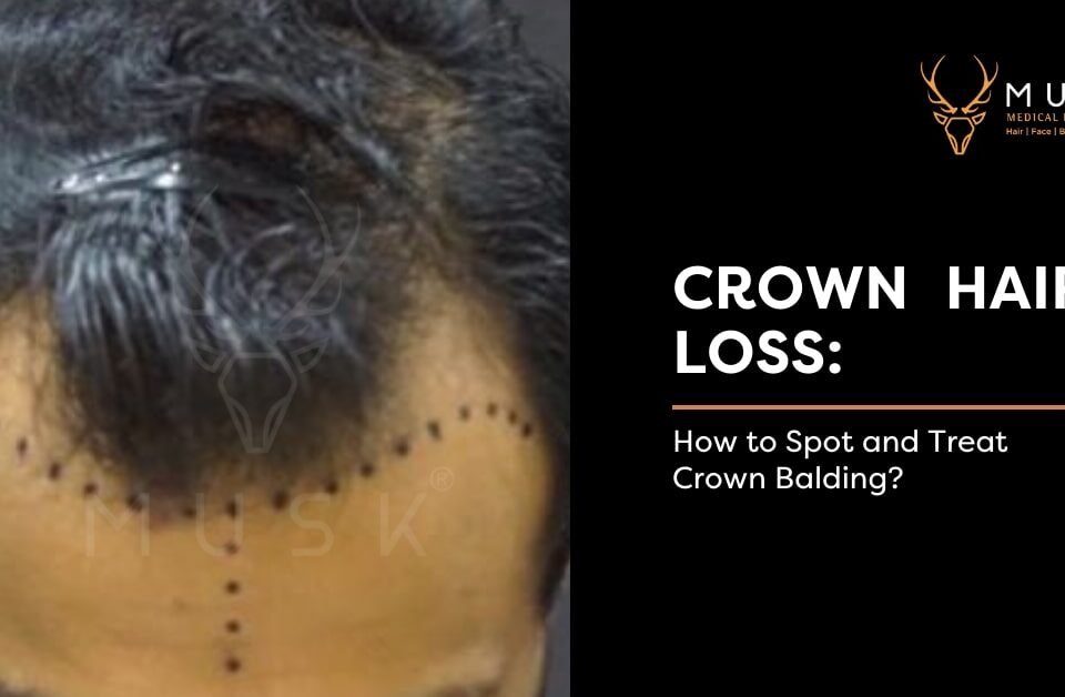 Crown-Hair-Loss-How-to-Spot-and-Treat-Crown-Balding