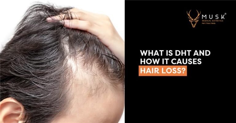 What is DHT and How It Causes Hair Loss?