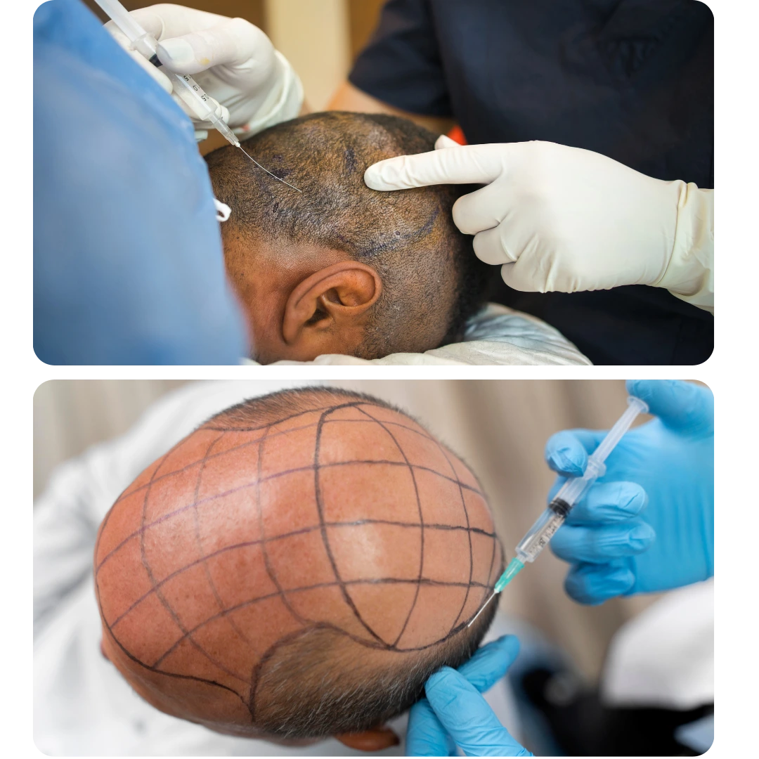 Best Hair Transplant in India