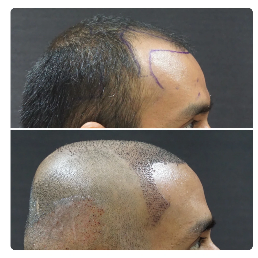 Best Revision Hair Transplant