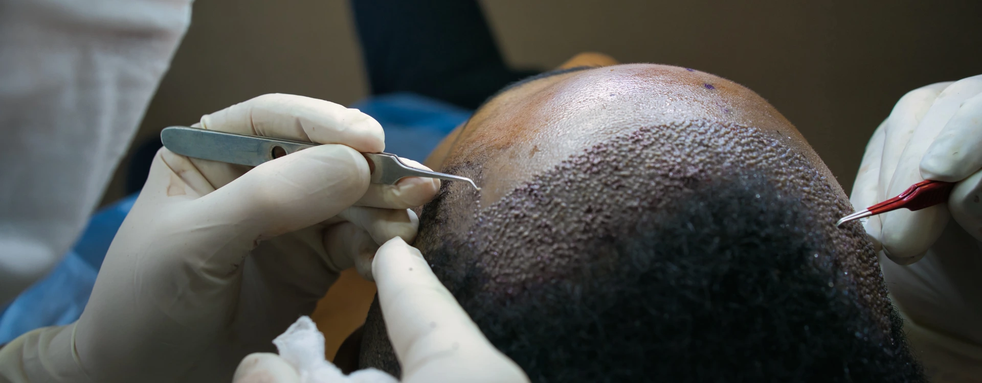 Hair Transplant