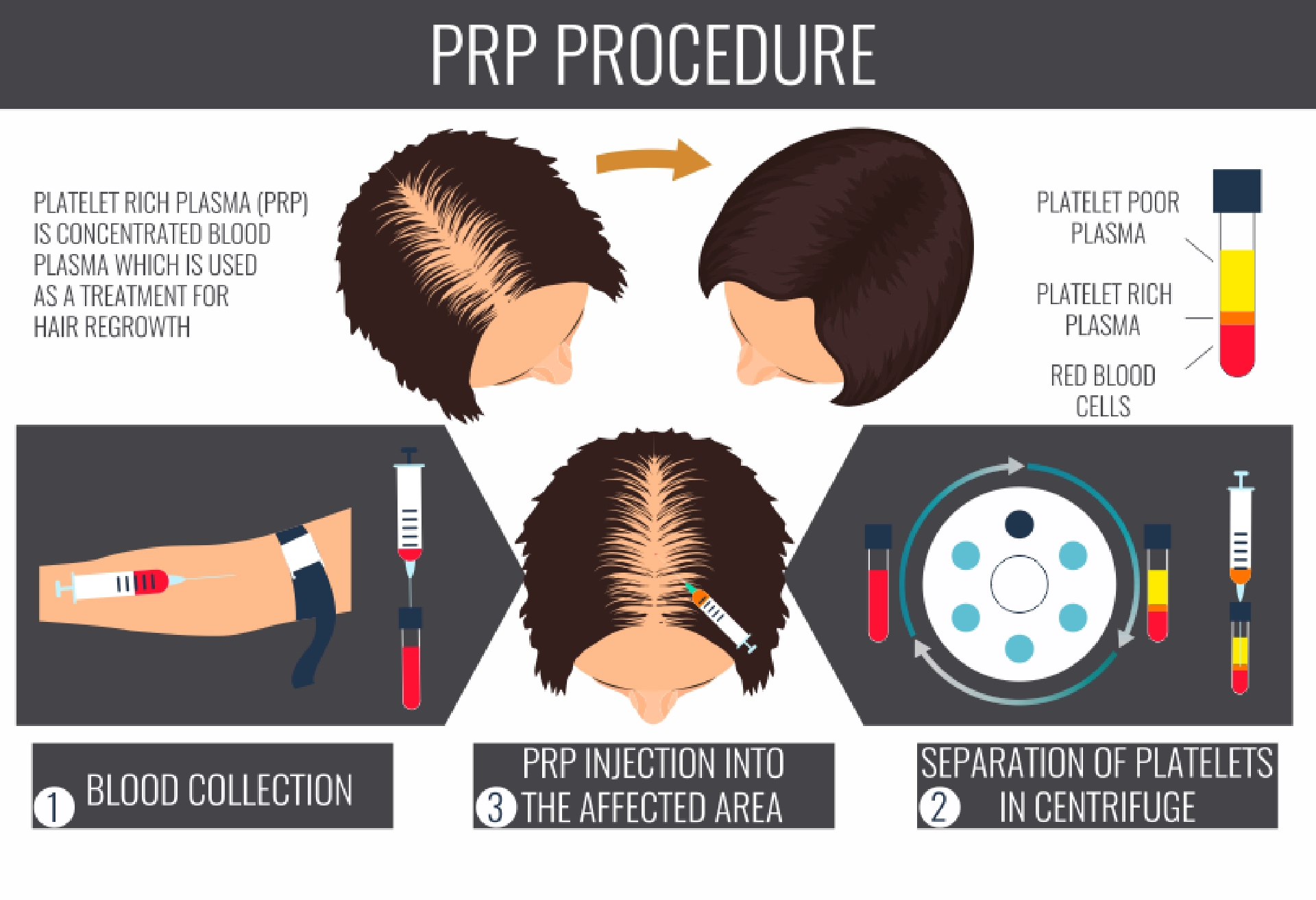 PRP Treatment in Ahmedabad for women