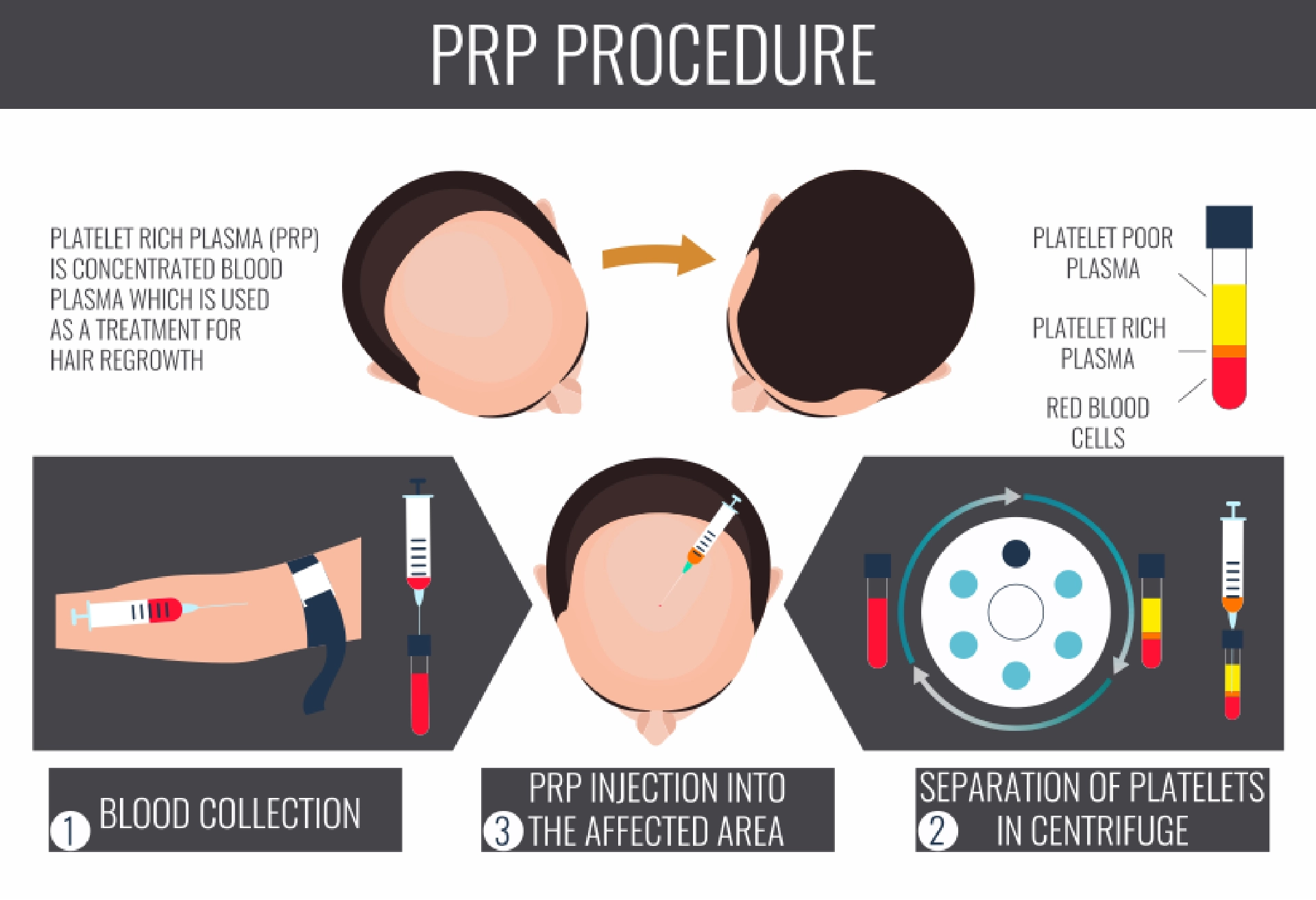 PRP Treatment in Ahmedabad