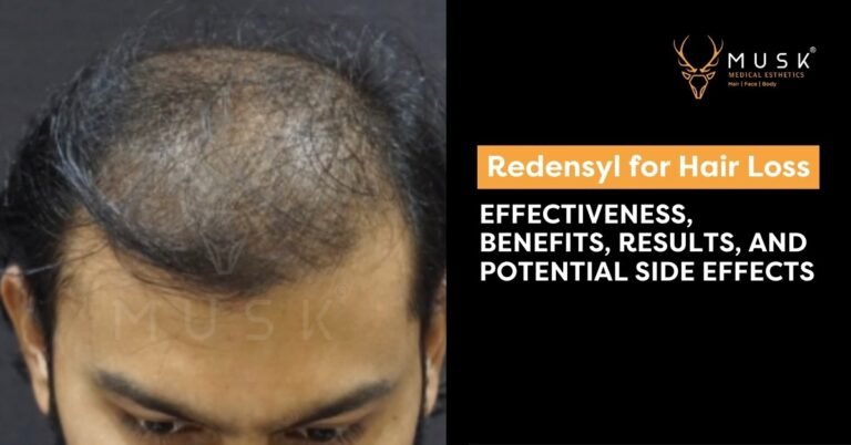 Redensyl for Hair Loss: Effectiveness, Benefits, Results, and Potential Side Effects