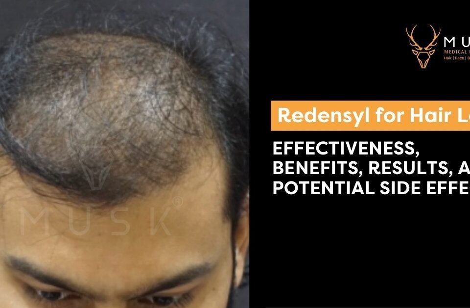 Redensyl for Hair Loss: Effectiveness, Benefits, Results, and Potential Side Effects