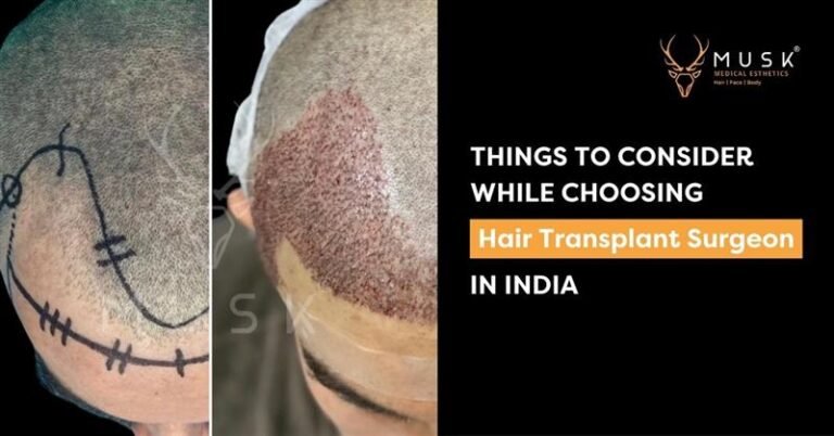 Things-to-Consider-While-Choosing-Best-Hair-Transplant-Surgeon-in-India