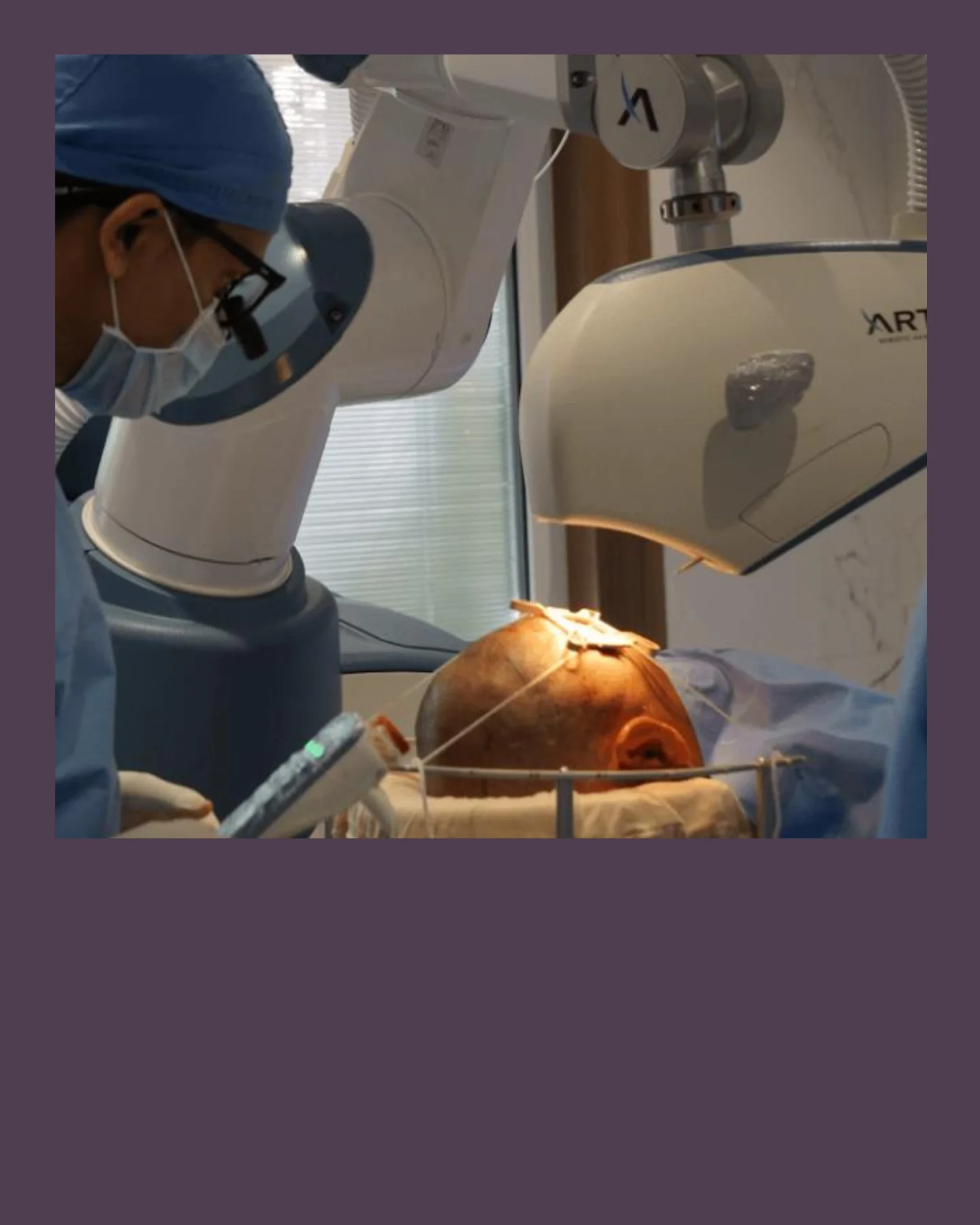 ARTAS 9x Robotic Hair Transplant in Ahmedabad, India