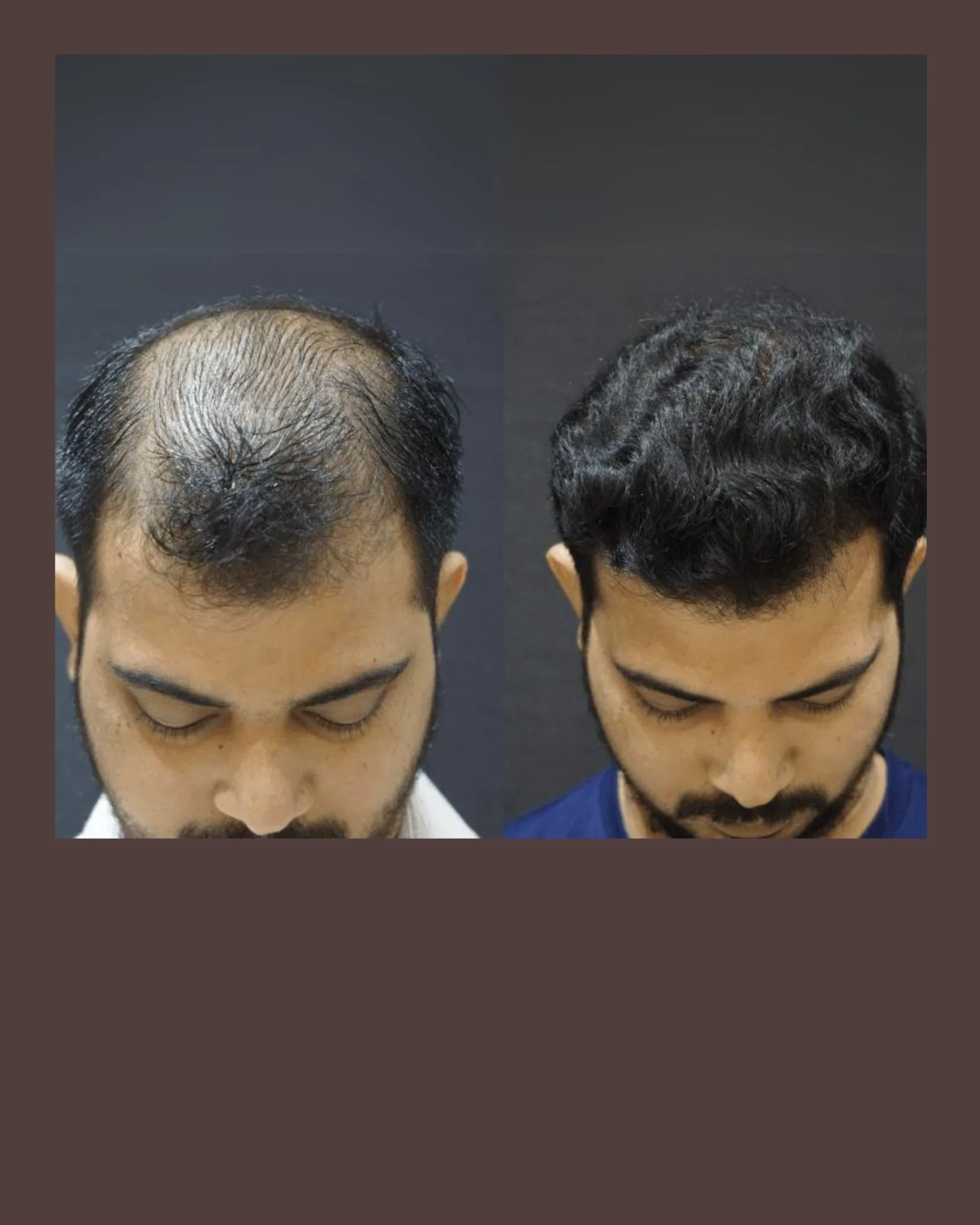 FUE Hair Transplant in Ahmedabad, India