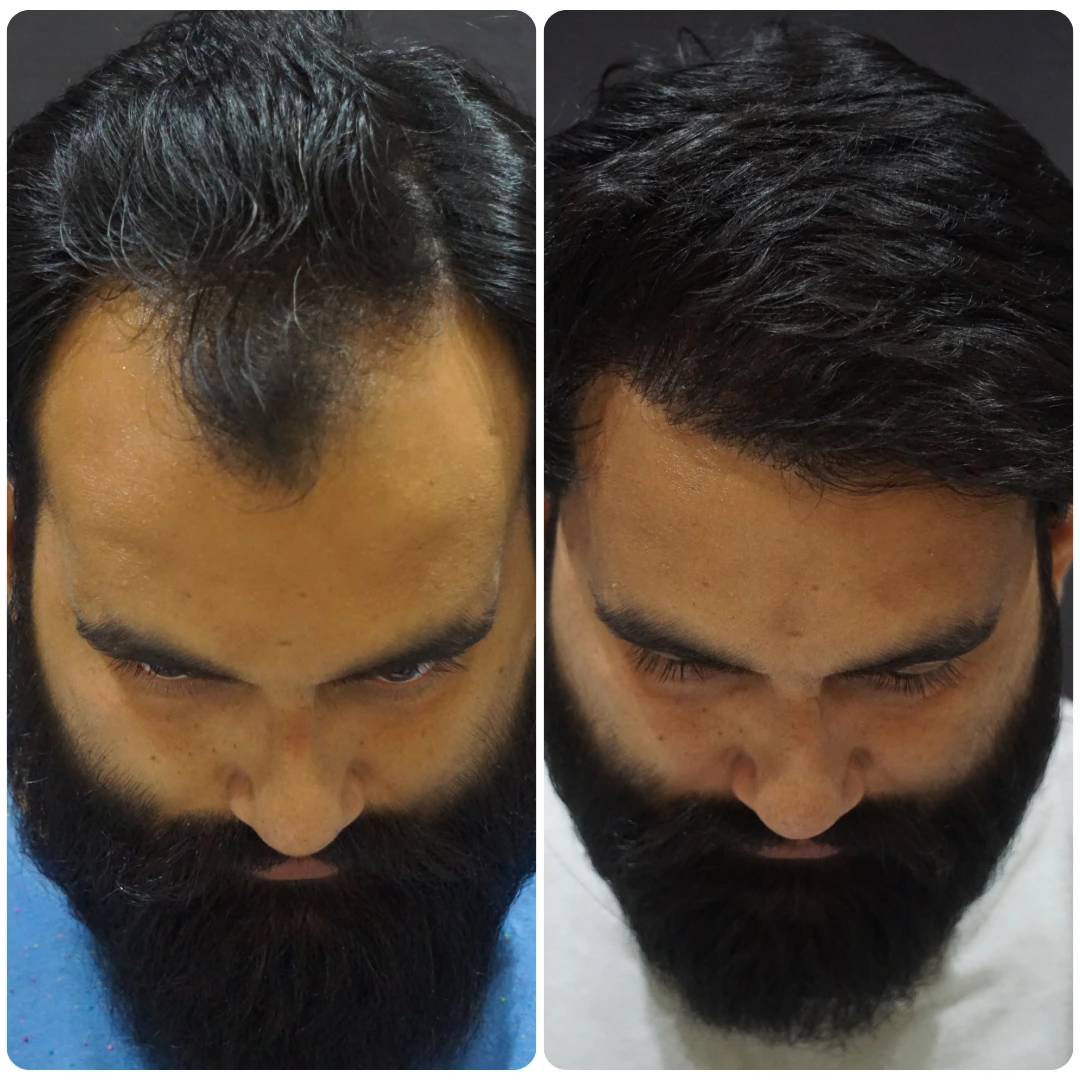 ARTAS Hair Studio Consultation