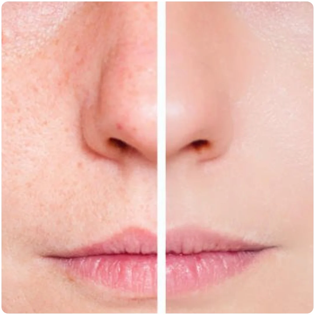 Benefits ZO 3 Step Peel