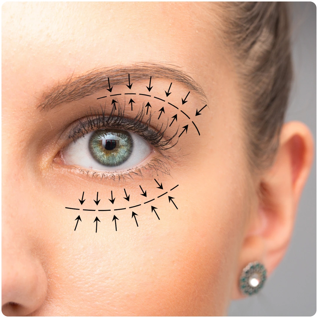 Blepharoplasty (2)