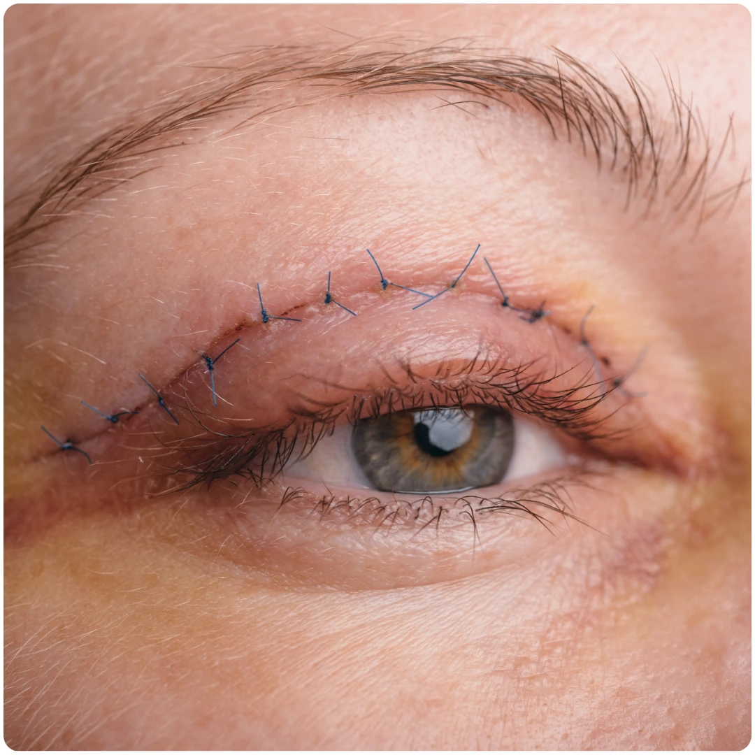Blepharoplasty