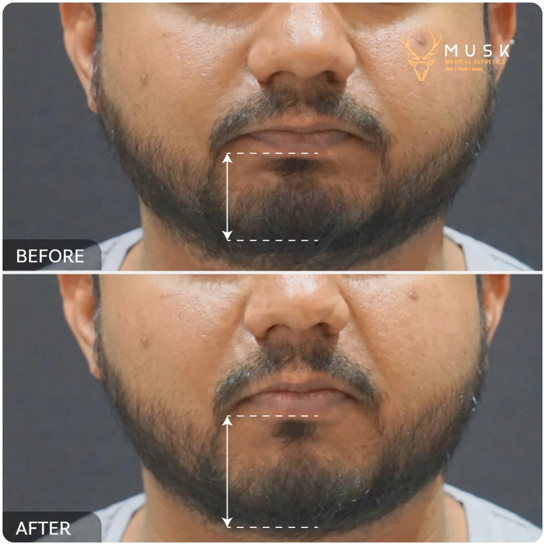 Cheek & Chin Augmentation 02