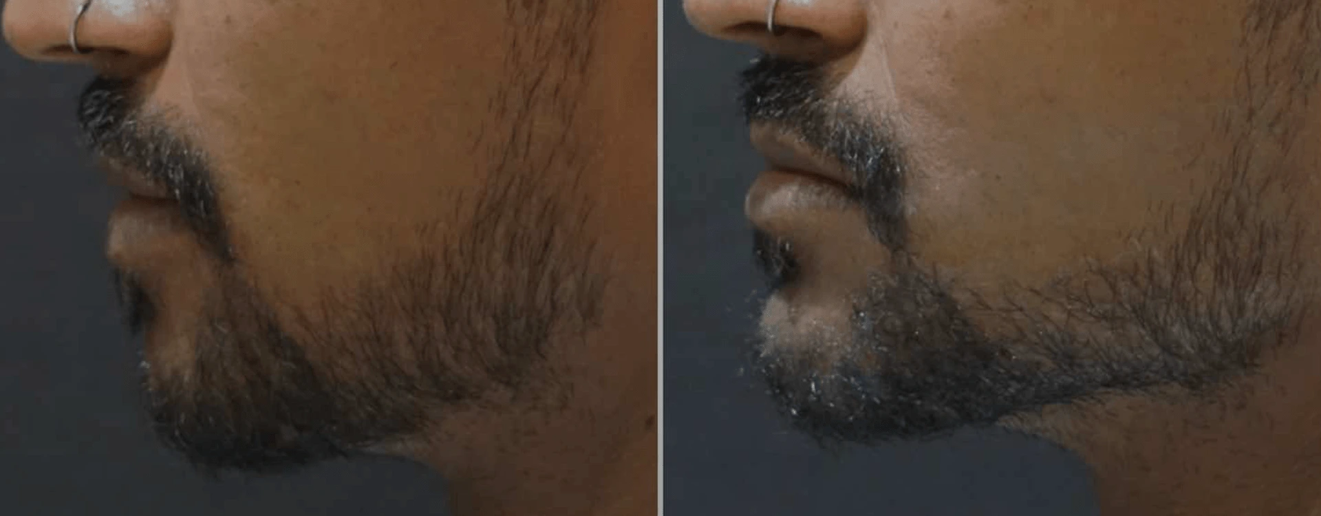 Cheek & Chin Augmentation