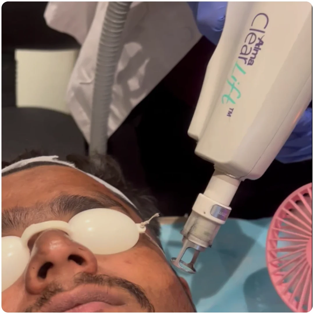 ClearLift Laser Facial