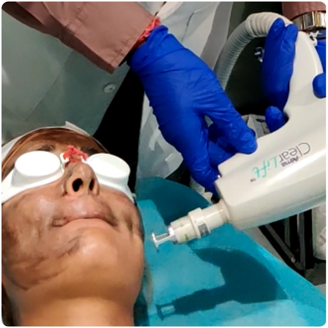 Clearlift Laser Facial