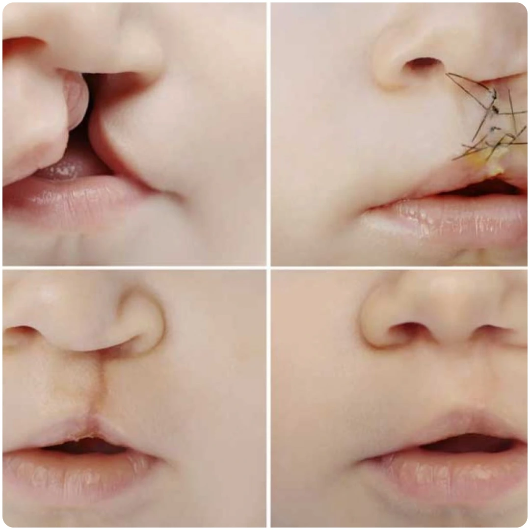 Cleft Lip & Palate Surgery