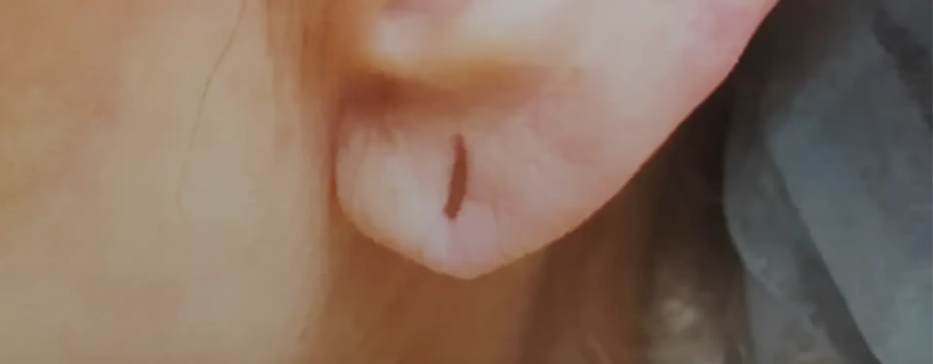 Ear Lobe Correction