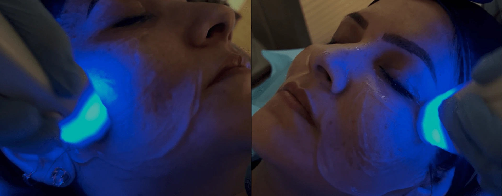 Hot Stone Face Lift