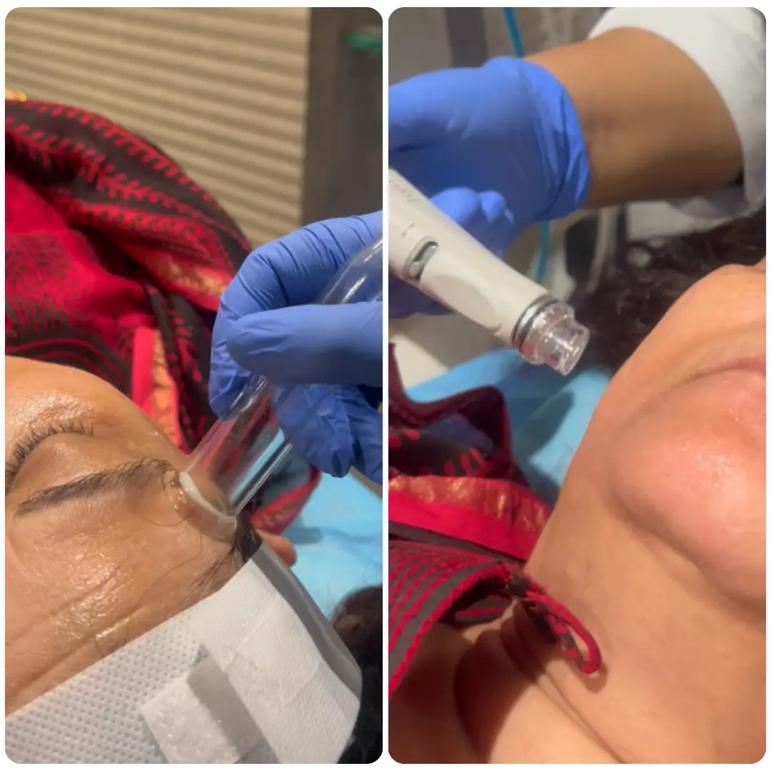 HydraFacial