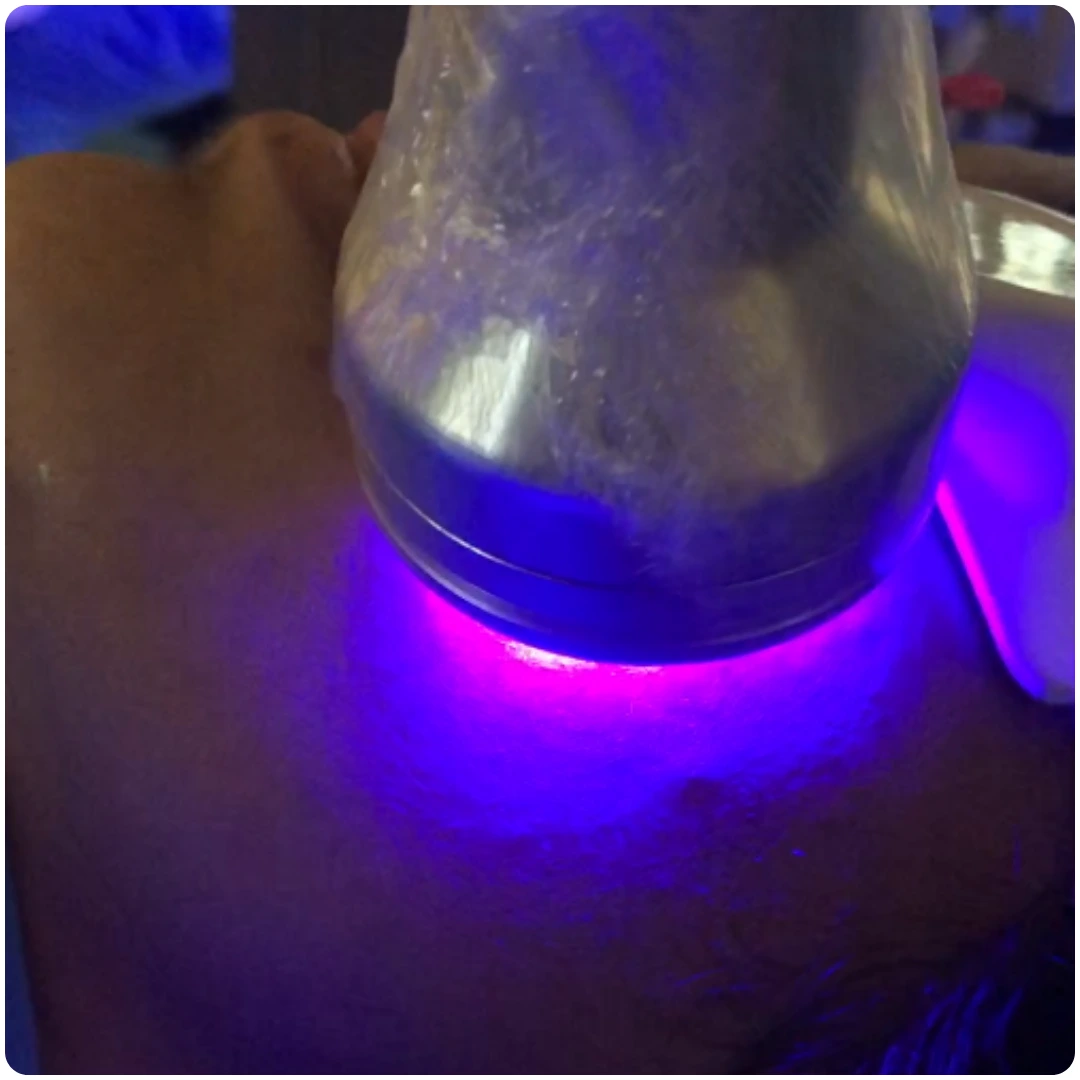 HydraFacial – Blue LED Light Therapy
