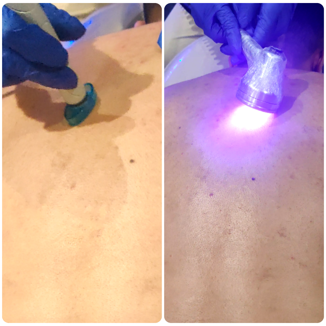 HydraFacial Skin Polish