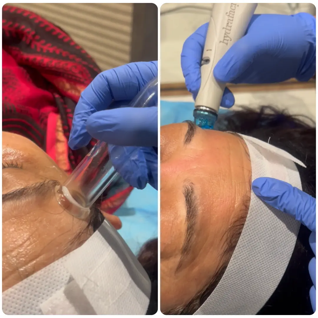 HydraFacial Treatment