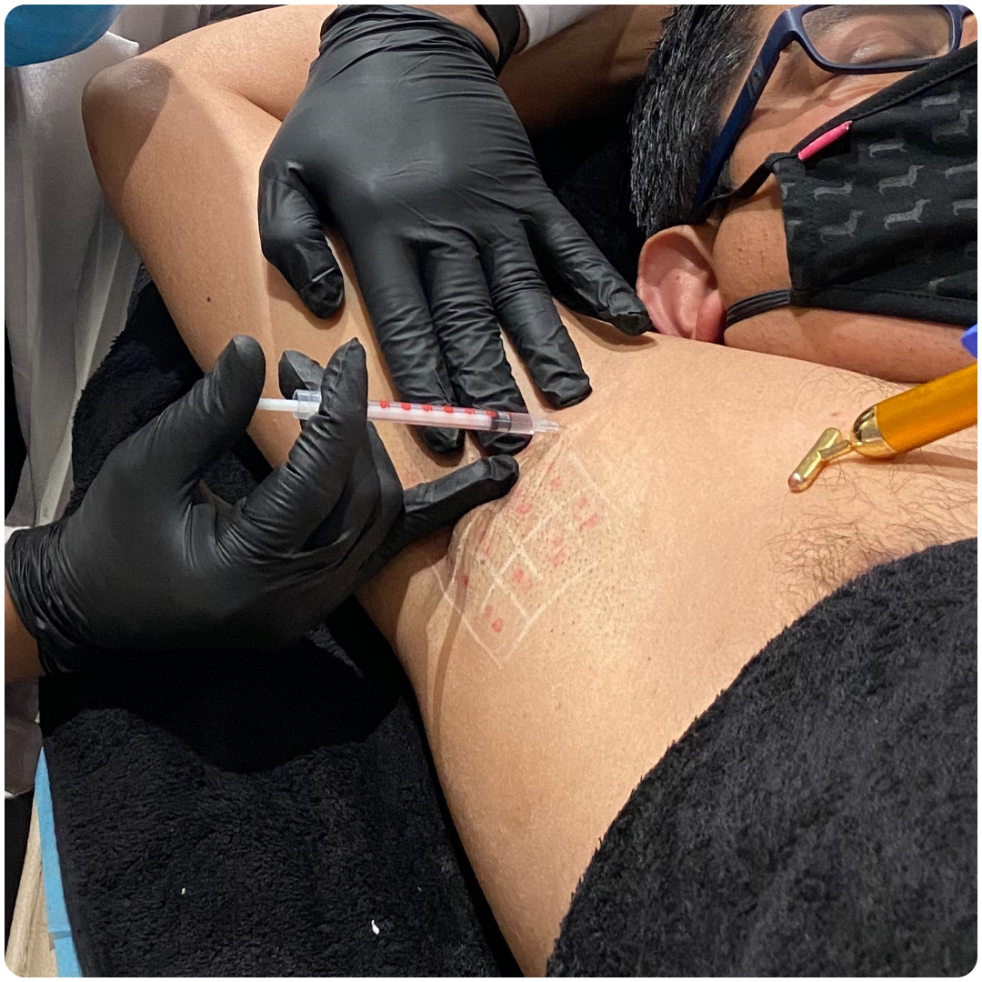 Hyperhidrosis Treatment 02