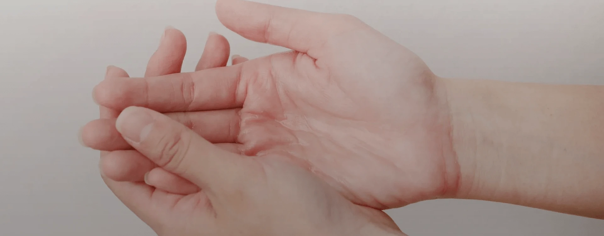 Hyperhidrosis Treatment, India