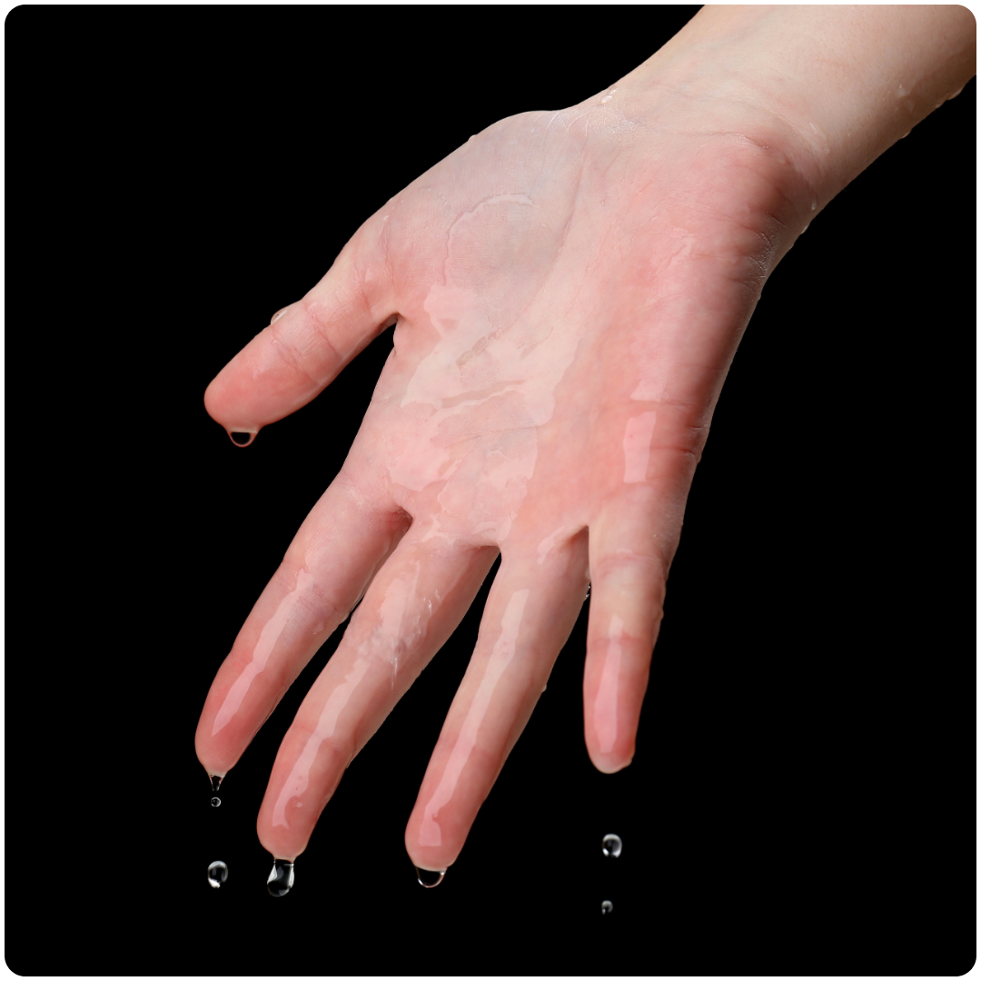 Hyperhidrosis Treatment