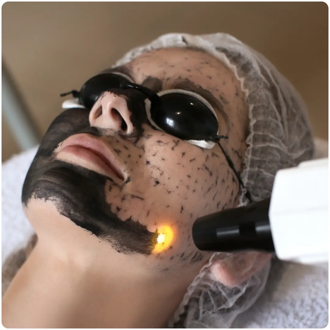 Laser Black-Out Facial Treatment