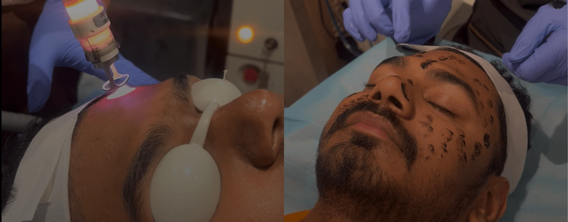 Laser Black-Out Facial