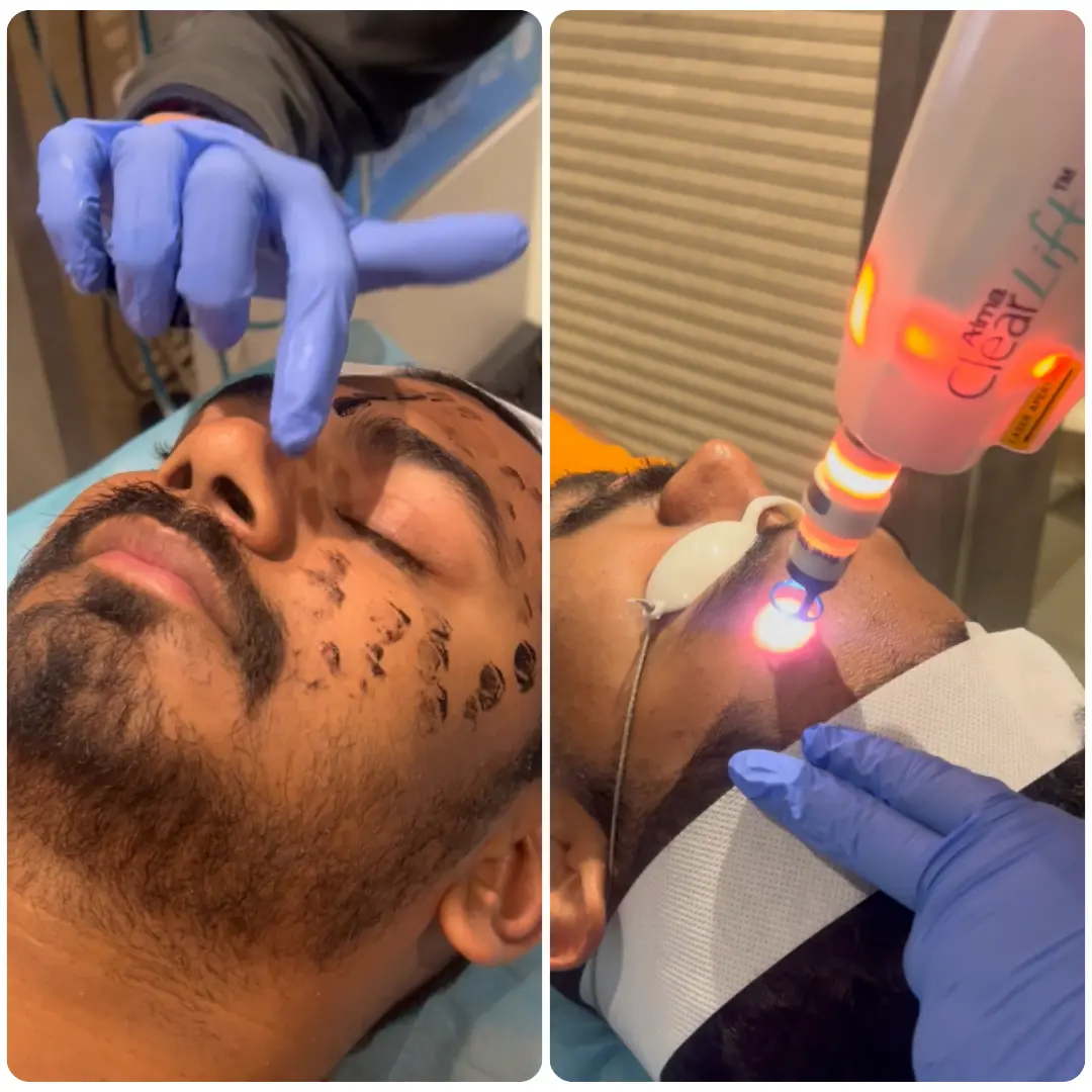 Laser Blackout Facial