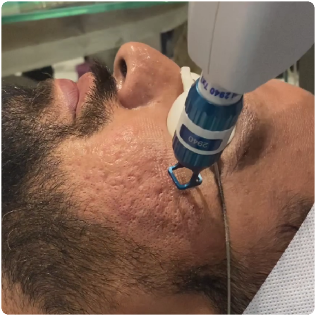 Laser Skin Resurfacing