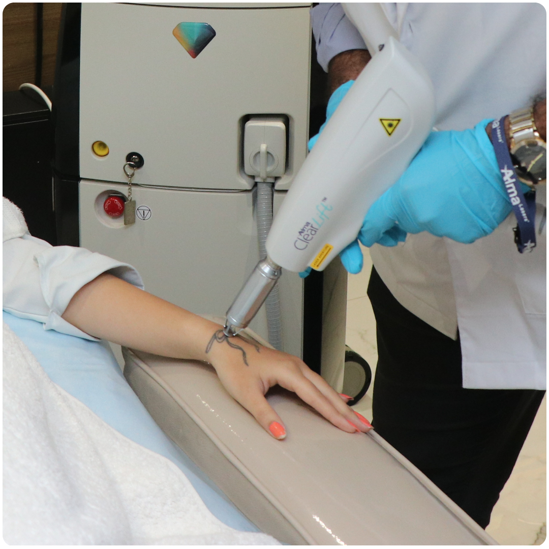 Laser Tattoo Removal