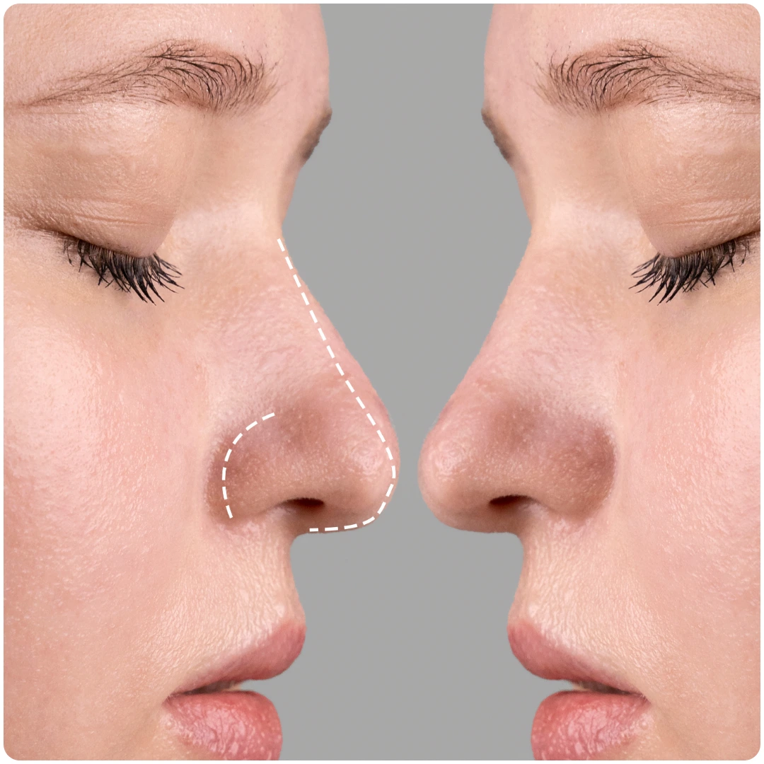 Rhinoplasty