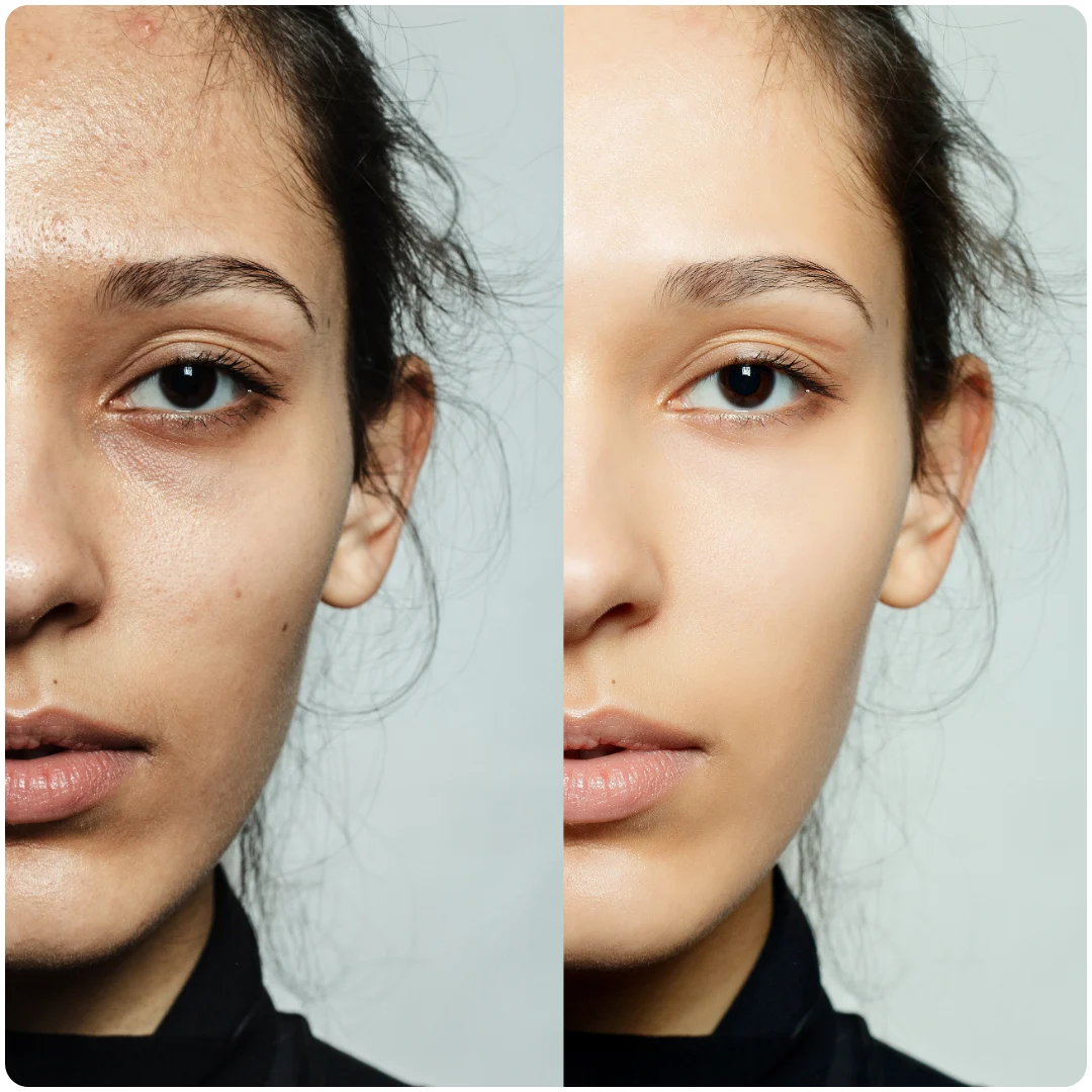 Skin Booster Therapy