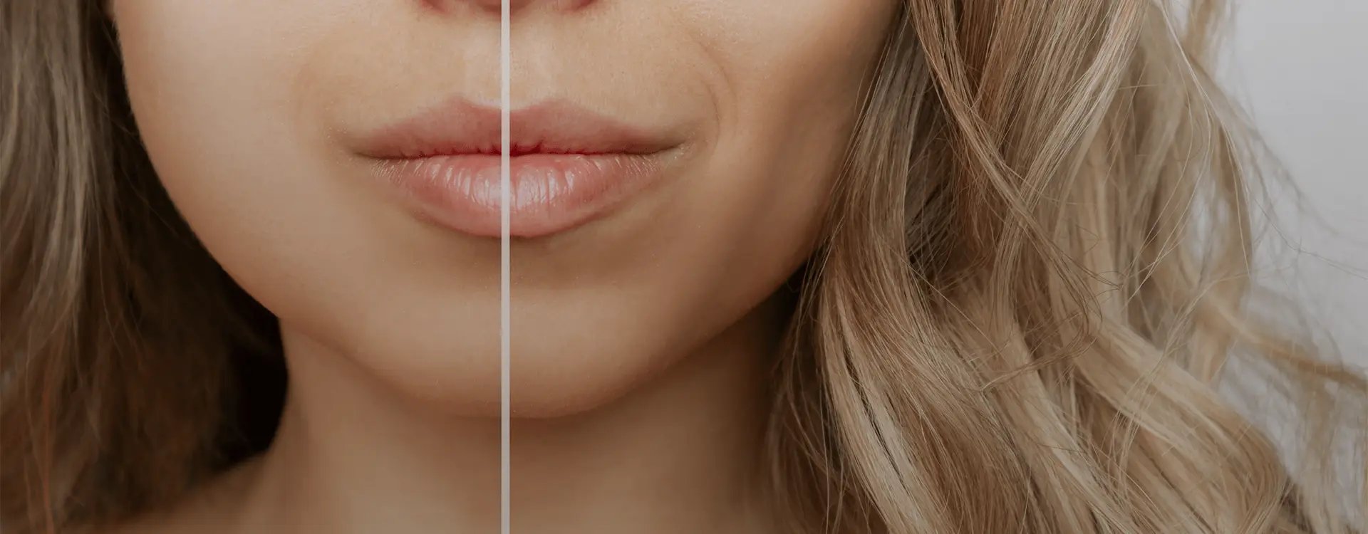 Thread Lift