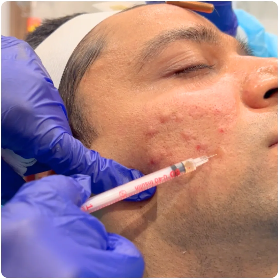 What Is Liquid Face Lift