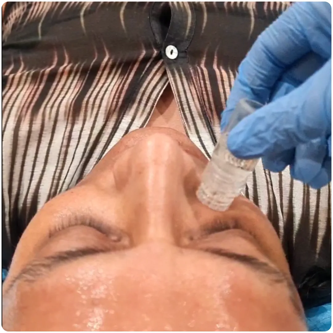 What Is Medical Skin Needling