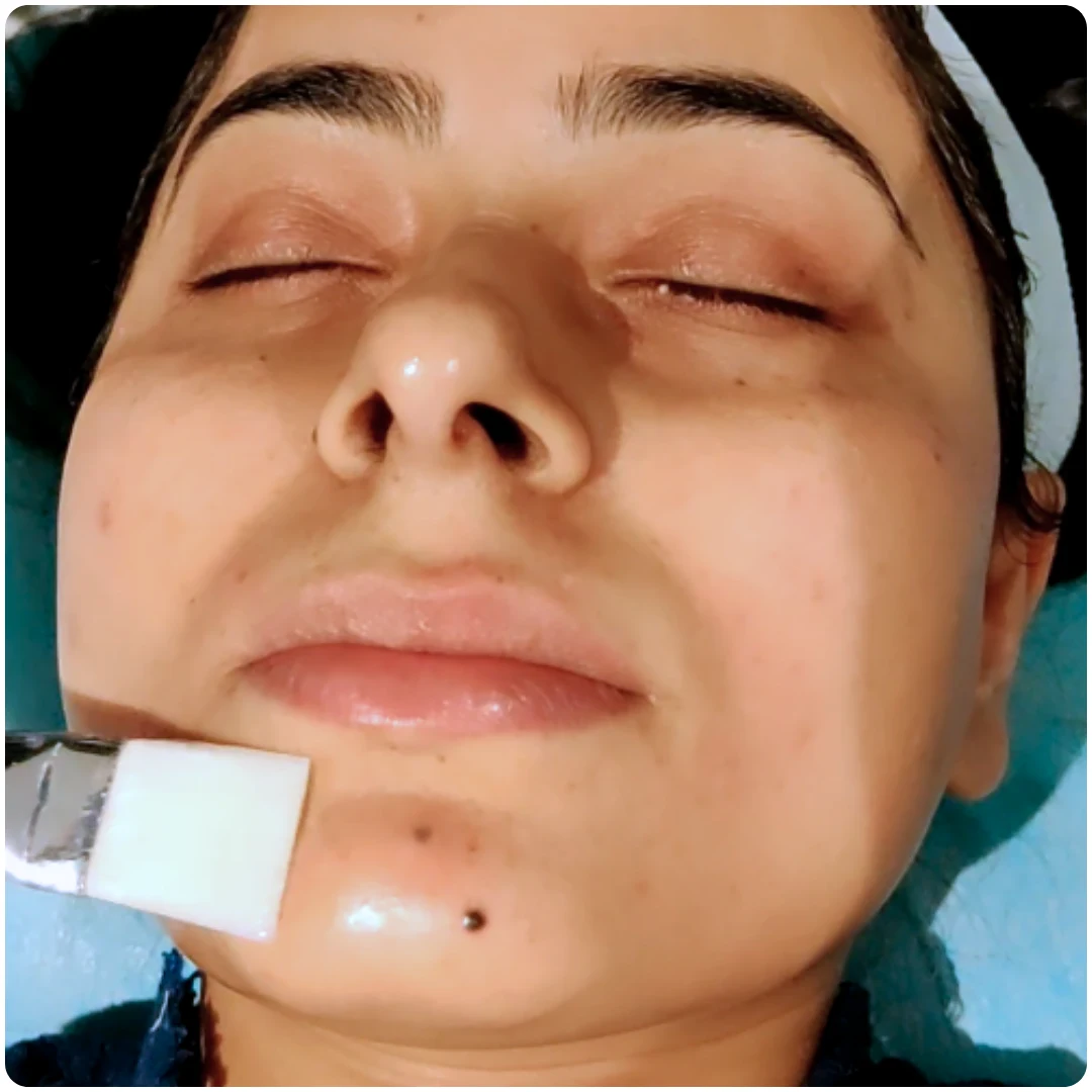 What are Chemical Peels